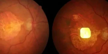 Implan Mata Bertenaga AI Bantu Pasien Buta Kembali Membaca Setelah Bertahun-Tahun Tanpa Penglihatan