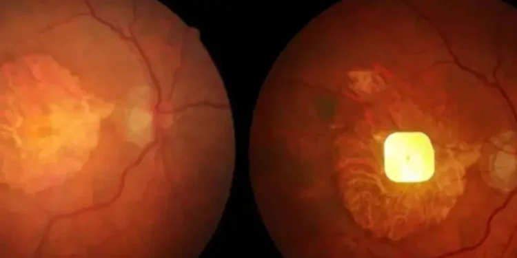 Implan Mata Bertenaga AI Bantu Pasien Buta Kembali Membaca Setelah Bertahun-Tahun Tanpa Penglihatan