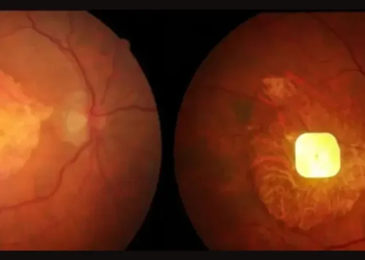 Implan Mata Bertenaga AI Bantu Pasien Buta Kembali Membaca Setelah Bertahun-Tahun Tanpa Penglihatan